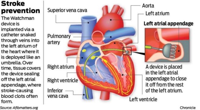 mapmg-cardiologists-perform-new-watchman-procedure-reduce-risk-of