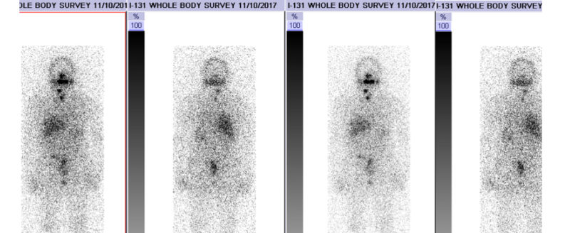 What Is Thyroid Cancer Iodine